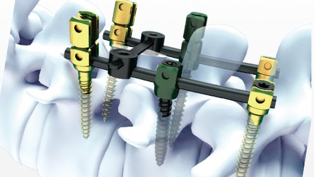 脊柱内固定系统