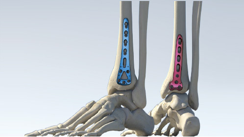 锁定接骨板系列