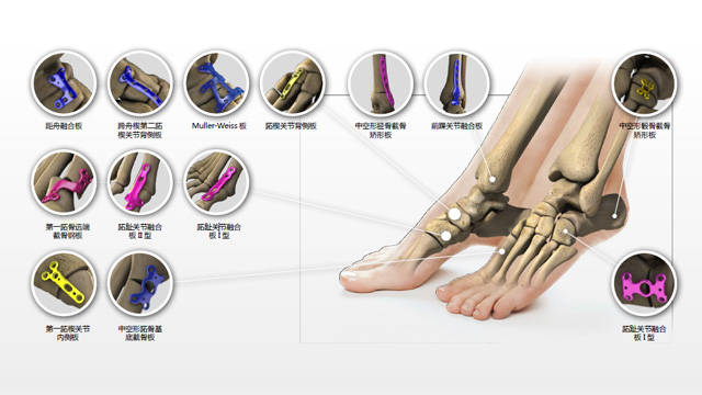 足踝内固定系统