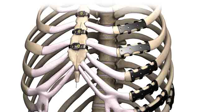 胸肋骨内固定系列