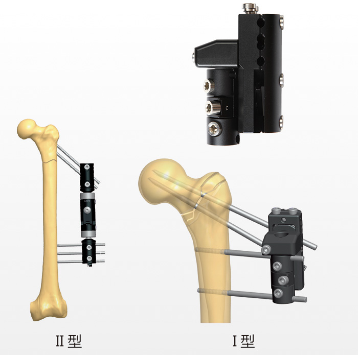 股骨粗隆间支架